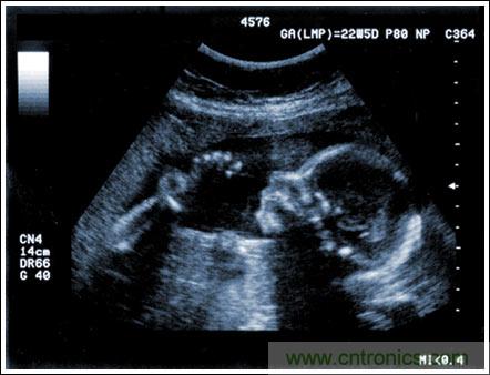 超聲成像係統及主要子功能電子元件的設計考慮